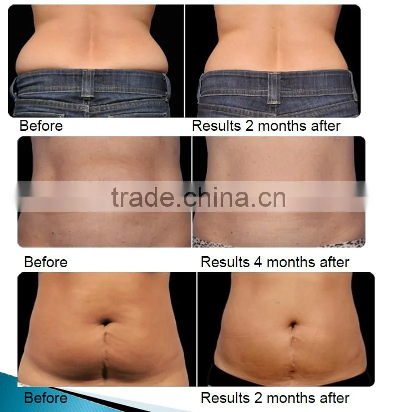CE / FDA approved beauty device velashape cavitation RF body shaping machine