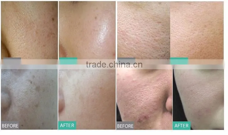 Negative pressure ionic face cleaning machine washing pores machine