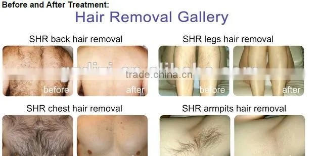 IPL/permanent hair removal,laser hair removal machine