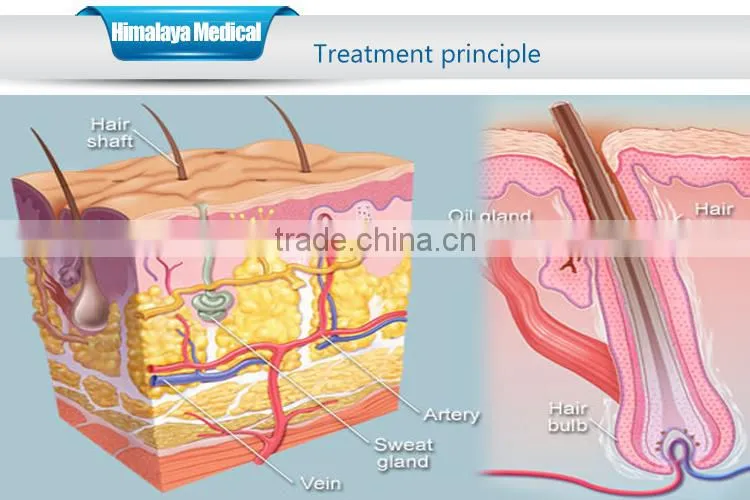CE Approval Best Supplier SHR OPT IPL Hair Removal
