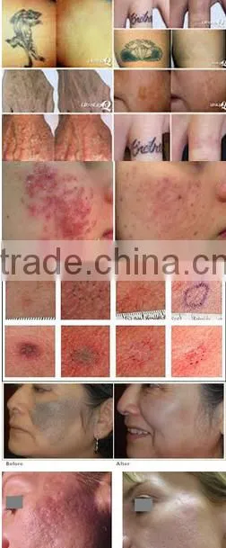 2016 high quality factory price q switch nd yag laser tattoo removal equipment
