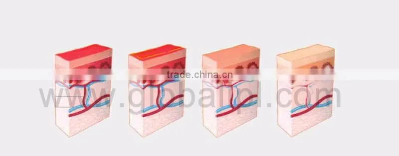 2016 Globalipl NEW MACHINE 980nm laser spider vein removal
