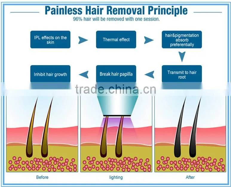 Permanent diode lazer hair removal machine