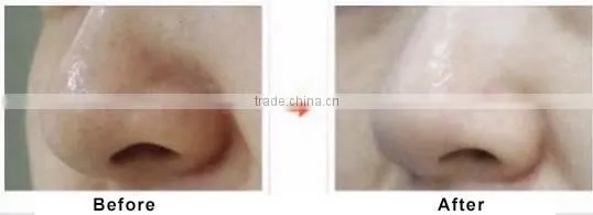 CE Certificated hydro facial dermabrasion spa equipment scrubber machine Hydrodermabrasion in alibaba