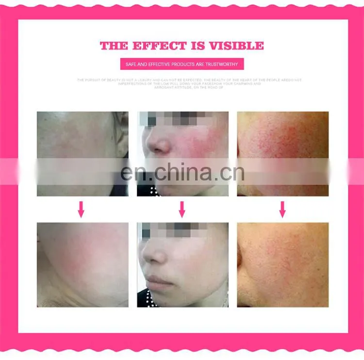 Portable spider veins vascular removal machine for salon use