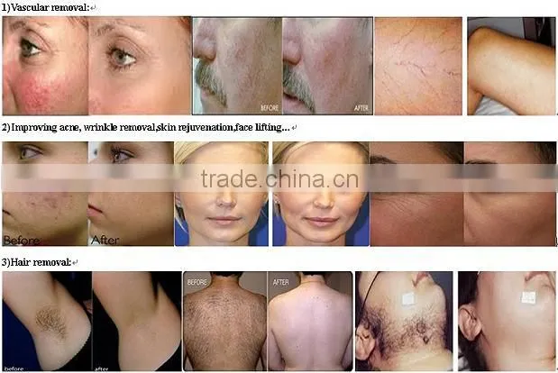 Hot selling elight machine with high quality