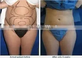 WS-30B Cool tech fat freezing machine