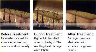 (EB-DL2) quick 808nm super shr diode laser for hair removal