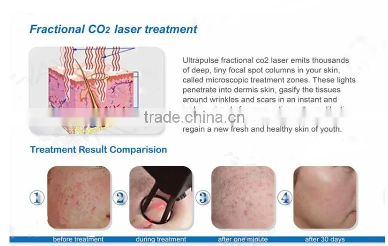 professional skin resurfacing co2 laser