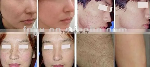 Excellent quality new products electroporation beauty machine