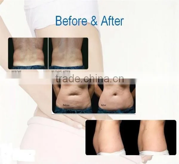 beauty and health best selling home cellulite machine