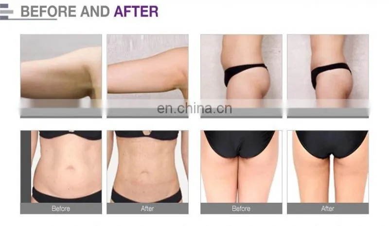Multifunctional slimming device vacuum rf roller cellulite machine vela