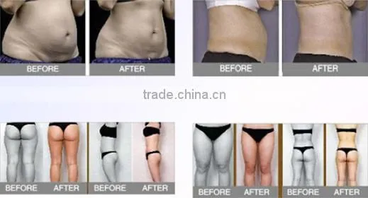 liposonix hifu/hifu system/liposonix
