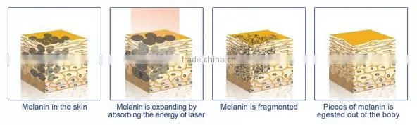 Merry christmas! 1064 532nm Tattoo Removal Active EO Q Switch ND YAG Laser machine with fast frenquency