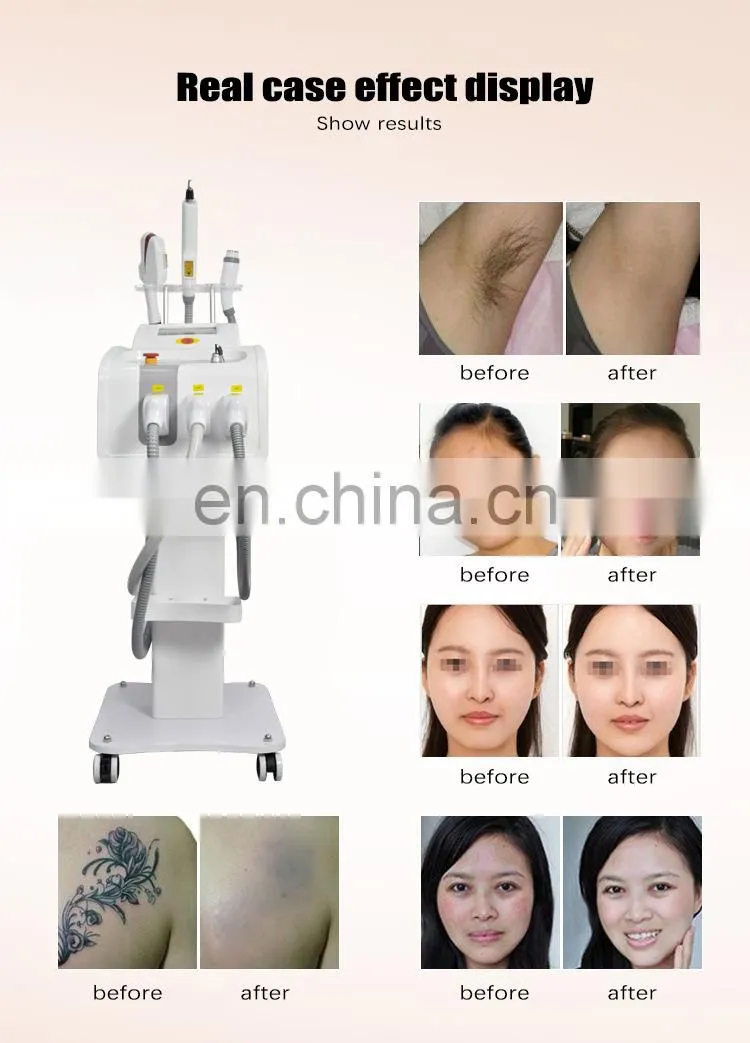 Newest Portable Acne Treatment Machine Laser Hair Removal Machine Skin Lifting Equipment Facial Hair Removal