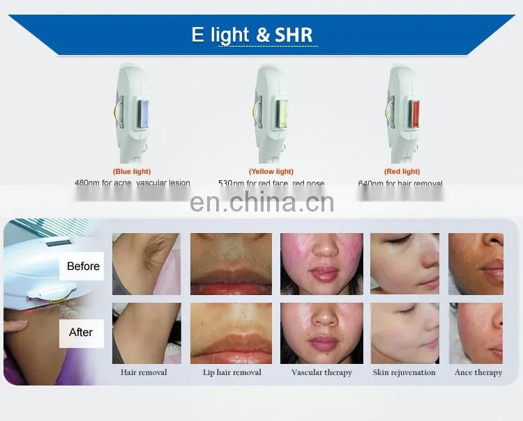 Factory Direct Sales IPL Laser Lair Removal Power Supply Photo Rejuvenation machine in Renlang Beauty Machine