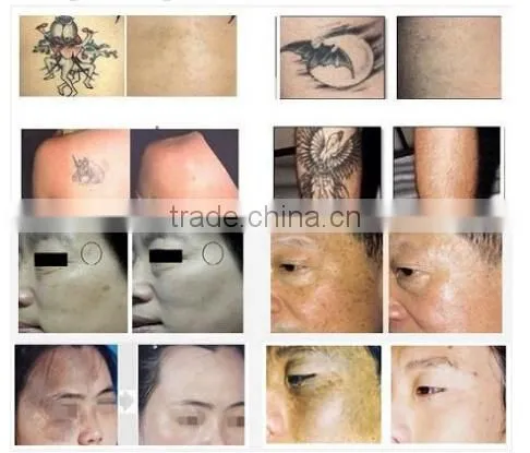 Economic Salon and Home Use Beauty Machine Portable IPL Laser Hair Removal Machine Price