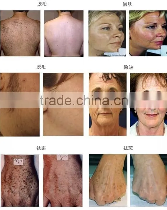 Double Handpieces Multifunctional IPL Laser Hair Removal Machine