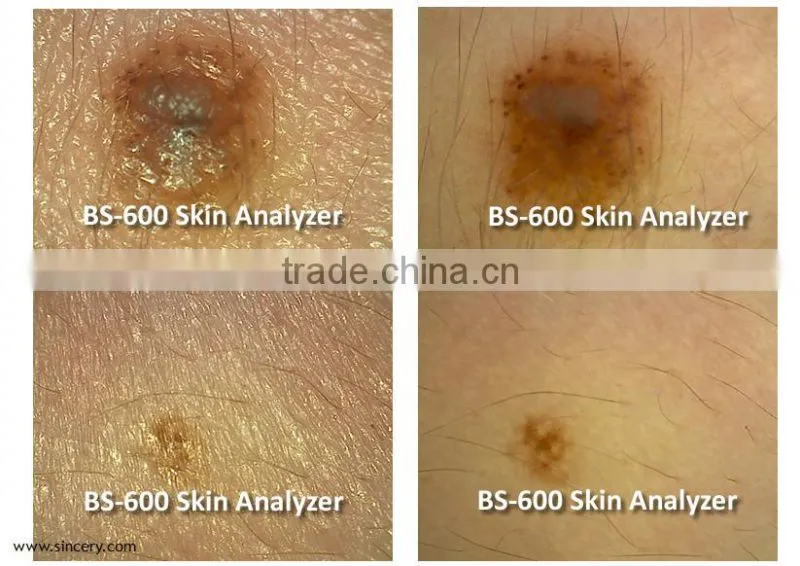 Portable high quality skin scanner/Mini skin and hair scanner