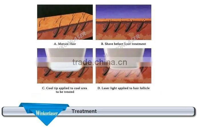 nono pro hair removal/diode laser hair removal