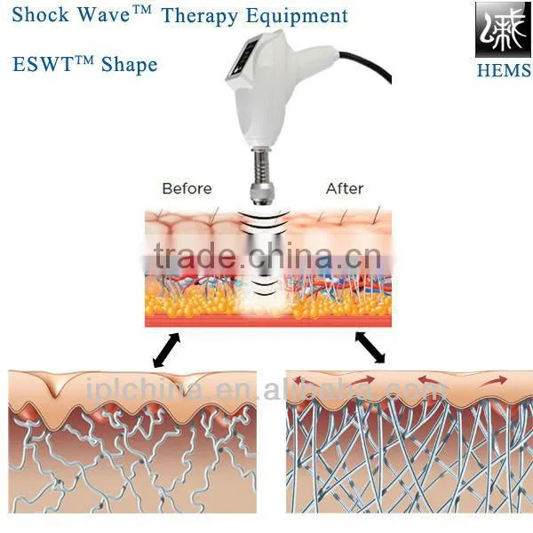 Body non surgical fat loss Equipment (ESWT Shape)