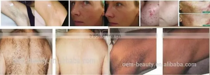 fast hair removal ipl shr hair removal and skin rejuvenation ipl machine shr hair removal
