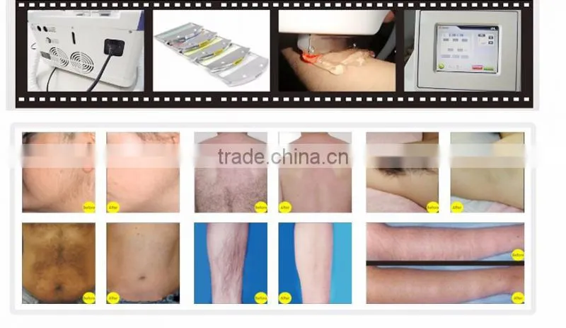 Bestview Portable IPL in home laser hair removal ipl device
