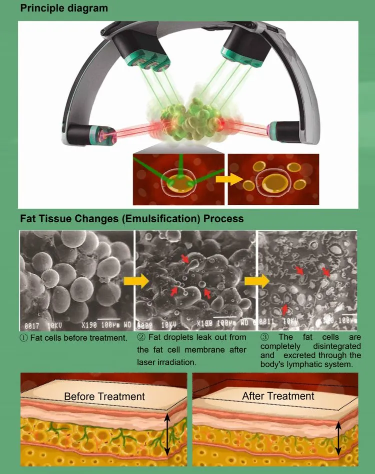 10d Laser Body Shape Machine Slim Cold Laser Therapy Device 10d Maxlipo Master 532nm Laser Machine