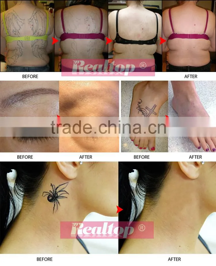 We looking for distributor q-switched nd:yag skin whitening & remove permanent tattoo machine / laser tatto removal machine