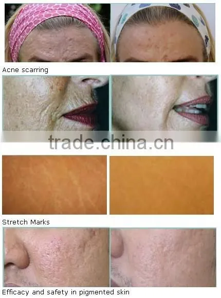 skin care roller/microneedle derma roller/microneedle roller