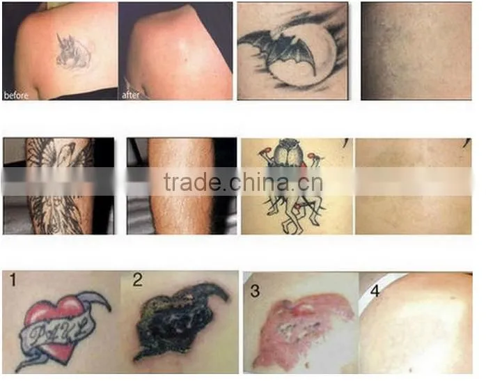 Brand Virtue Beauty 2016 Powerful ND YAG LASER tattoo removal