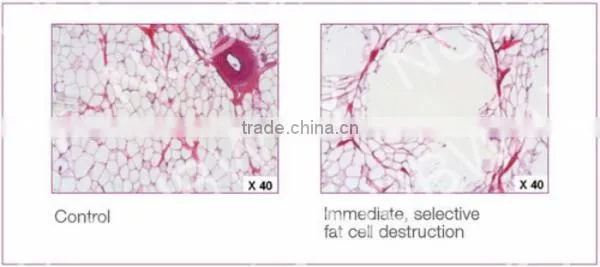 HIFU Body Fat Slimming! Professional Hifushape machine personal body care new hifu