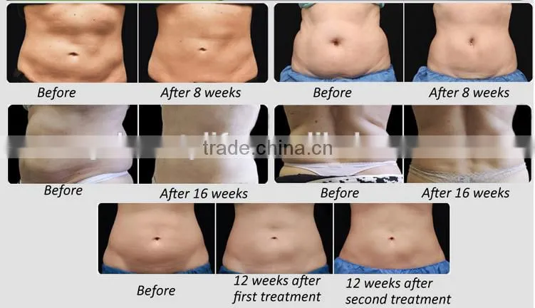 2016 best beauty machine cryolipolysis machine