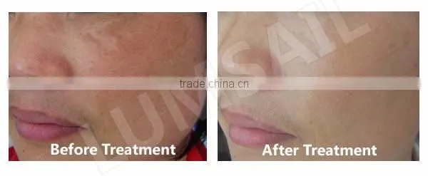 2016 Skin care LED phototherapy lamp machine
