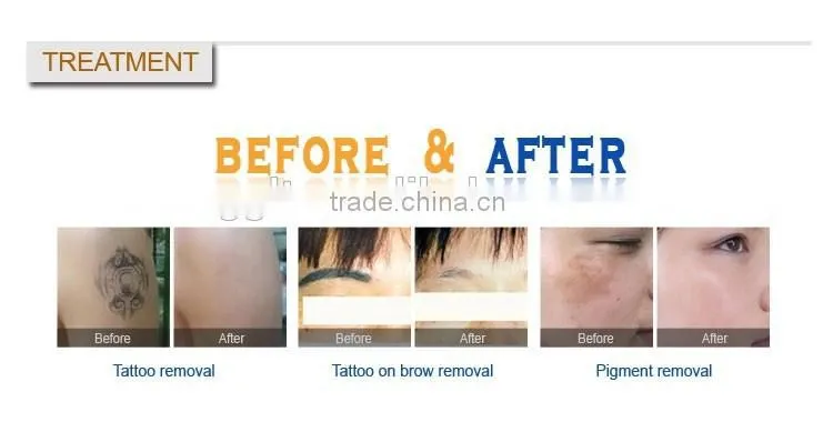 Christmas promotion 2000mj big power q switch nd yag laser