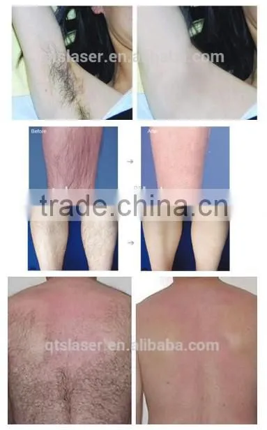 Permanent hair removal machine for beauty clinic salon