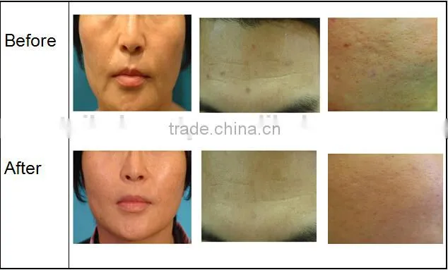 portable RF machine RF eye lifting machine RF Lifting Face Beauty Machine