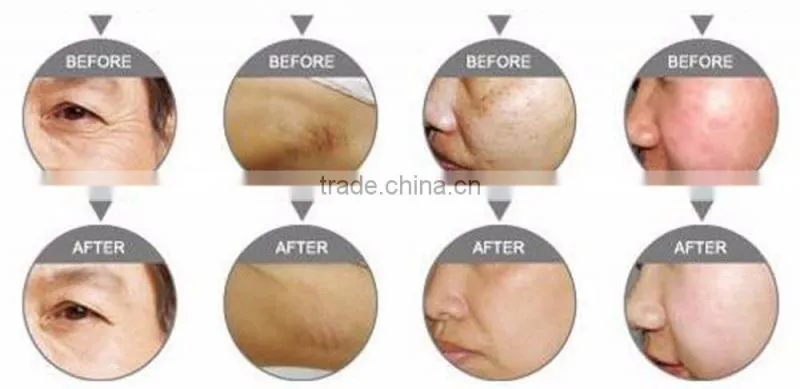 Professional ipl hair removal , powerful beuaty laser ipl