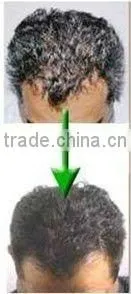 BREAKTHROUGH HAIR LASER TREATMENT
