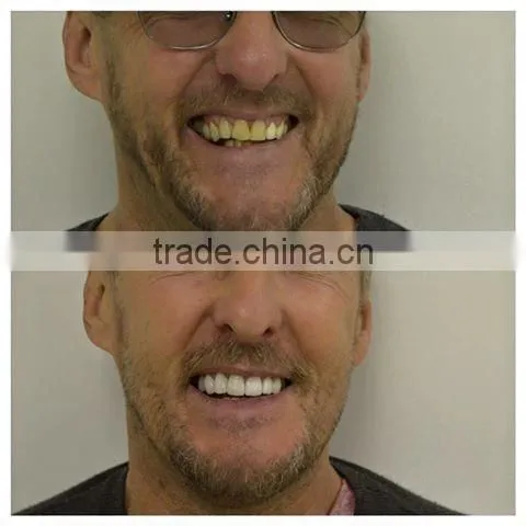 teeth whitening bleaching system gel kit