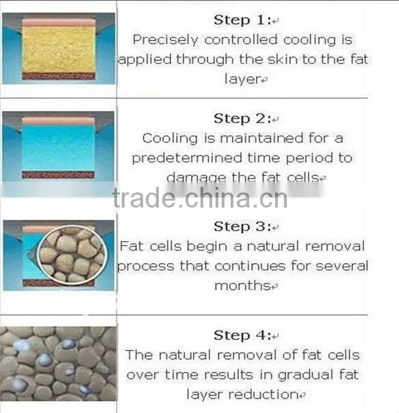 LN-164S freezing fat lipo cryo machine
