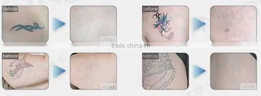 High performance 3 probe painless tattoo removal machine