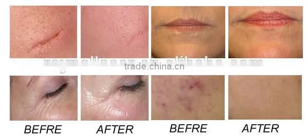 Best Quality 60W COHERENT RF Tube FractionalCO2 Laser Scar Removal Machine