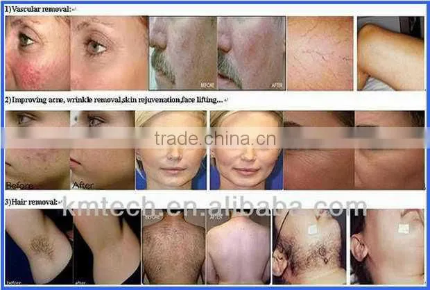 Safety&Cheap elight hair removal machine with ISO/CE/TUV certificate