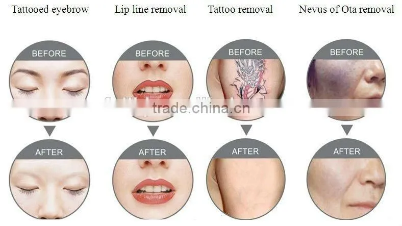 2015 Latest Technology Q-switched Nd Yag Laser Tattoo Removal/laser Tattoo Ink Remover