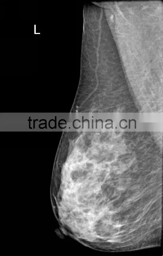 Digital Mammography System