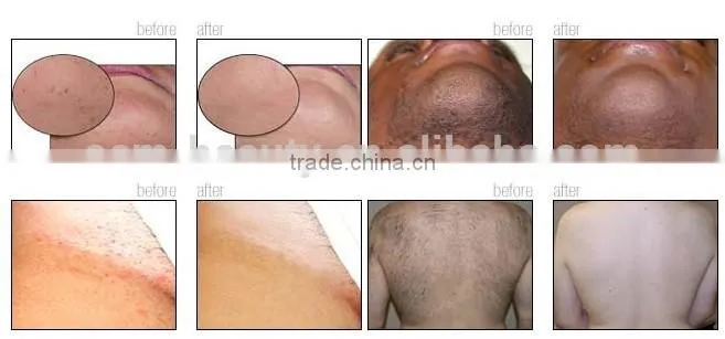 Nd Yag Laser for Varicose Veins/blood Vessel/ hair laser removal machine