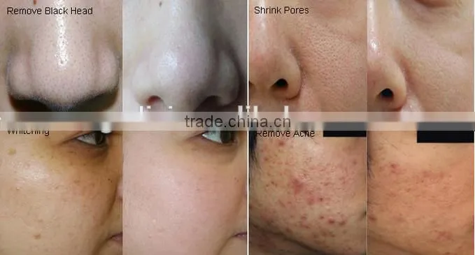 Water oxygen jet peel oxygen machine skin rejuvenation/ jet peel oxygen machine/oxygen and water jet