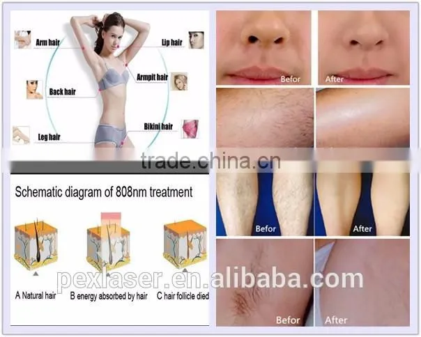 Portable diode laser hair removal equipment 808nm diode laser