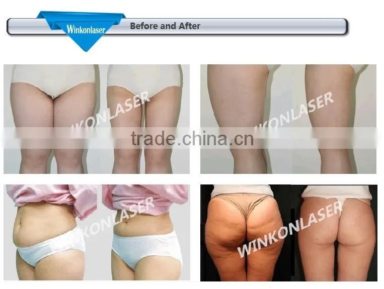 laser lipolysis machine / laser lipolysis